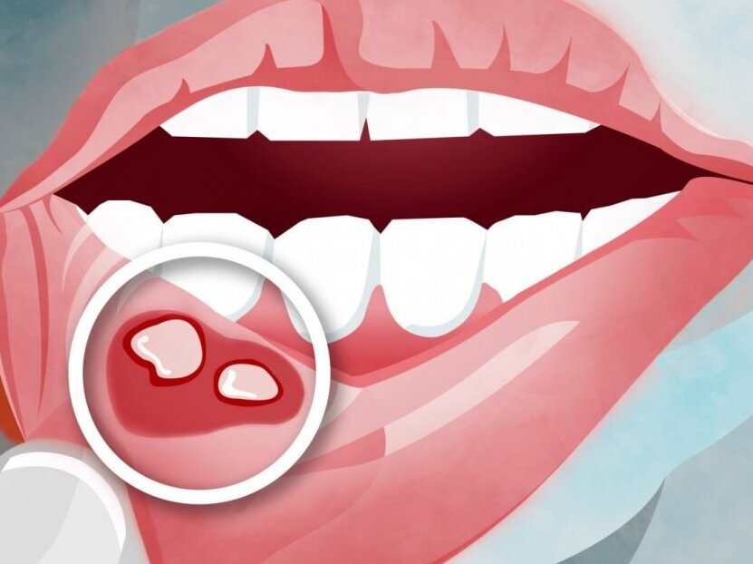 Шарик внутри губы - Стоматология - - Здоровье витамин-п-байкальский.рф